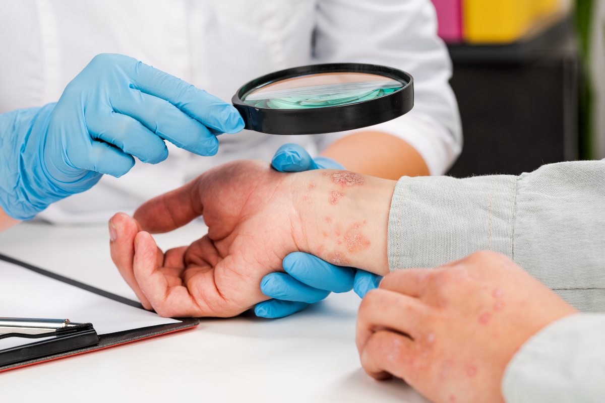Nummular Eczema – How to Recognize and Manage It for Skin Health Recovery?
