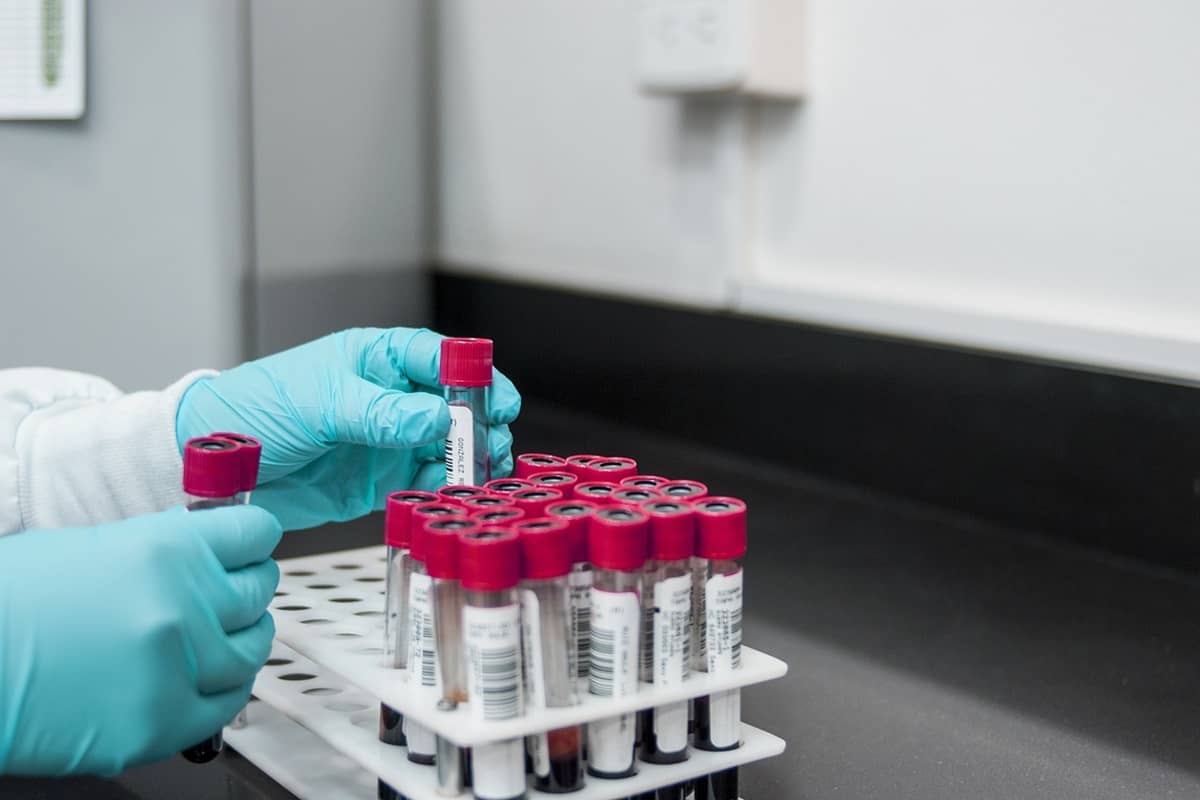 Homocysteine – Definition, Normal and Abnormal Levels, and Associated Conditions