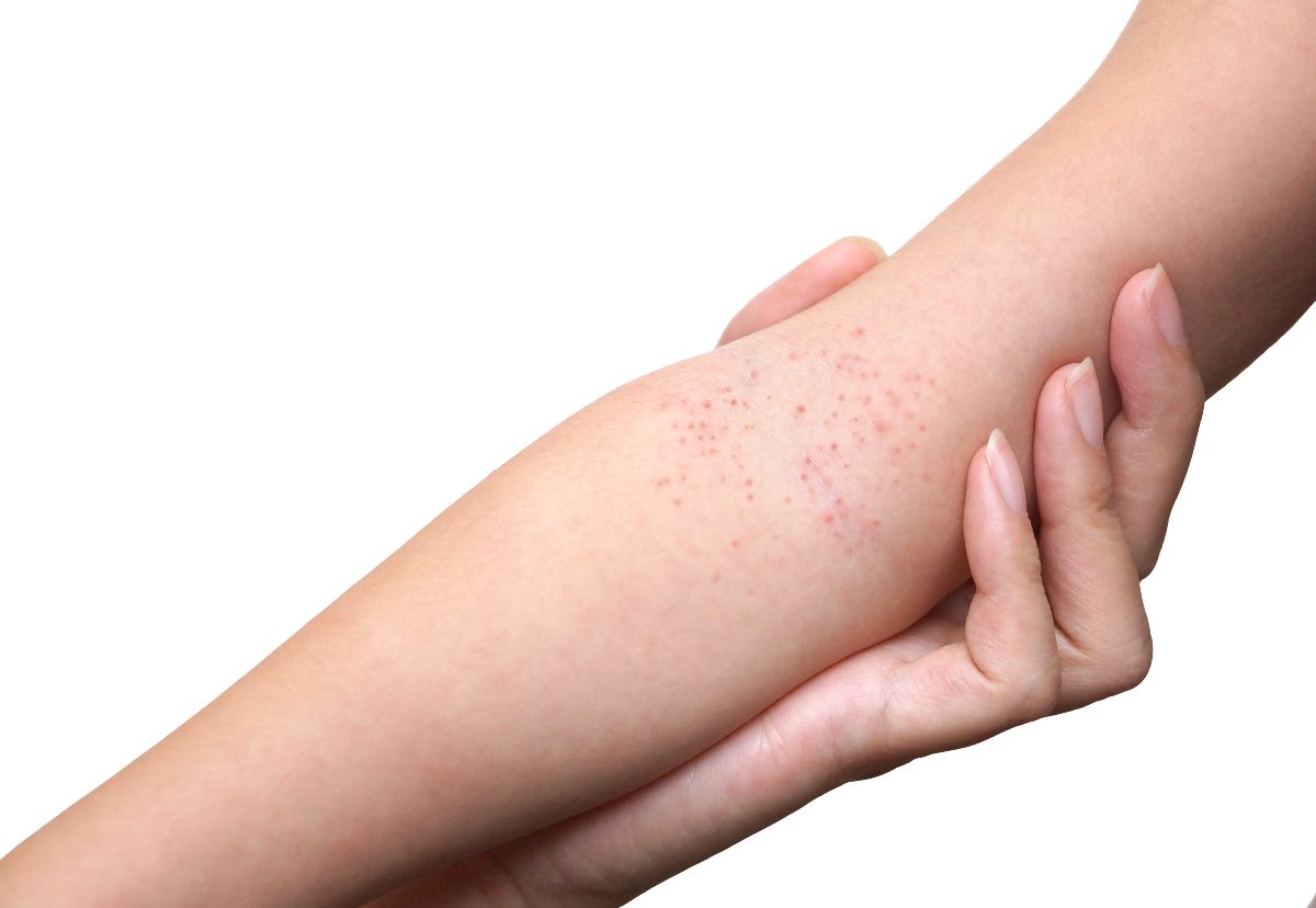Roseola Infantum – Manifestation in Children and Adults, Identification, and Symptom Relief Recommendations