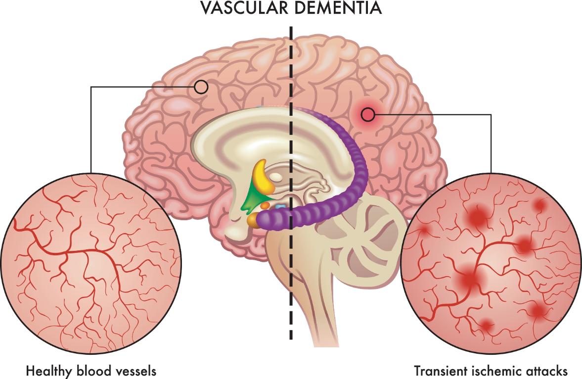 All About Vascular Dementia: Causes, Symptoms, and Treatment Options