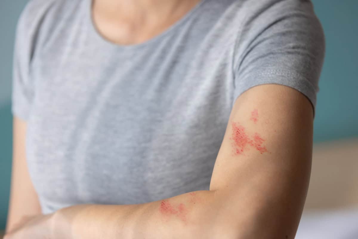 Shingles Vitamins – A Condition That Can Strike Anytime
